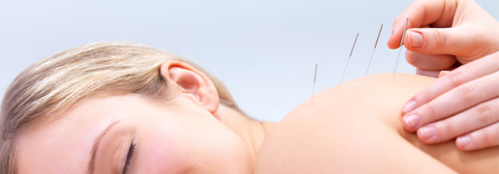 Chiropractic Harrisburg NC Acupuncture & Dry Needling